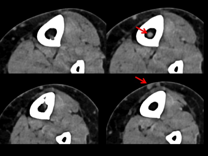 Figure 3 for case varix ( RID3366 )